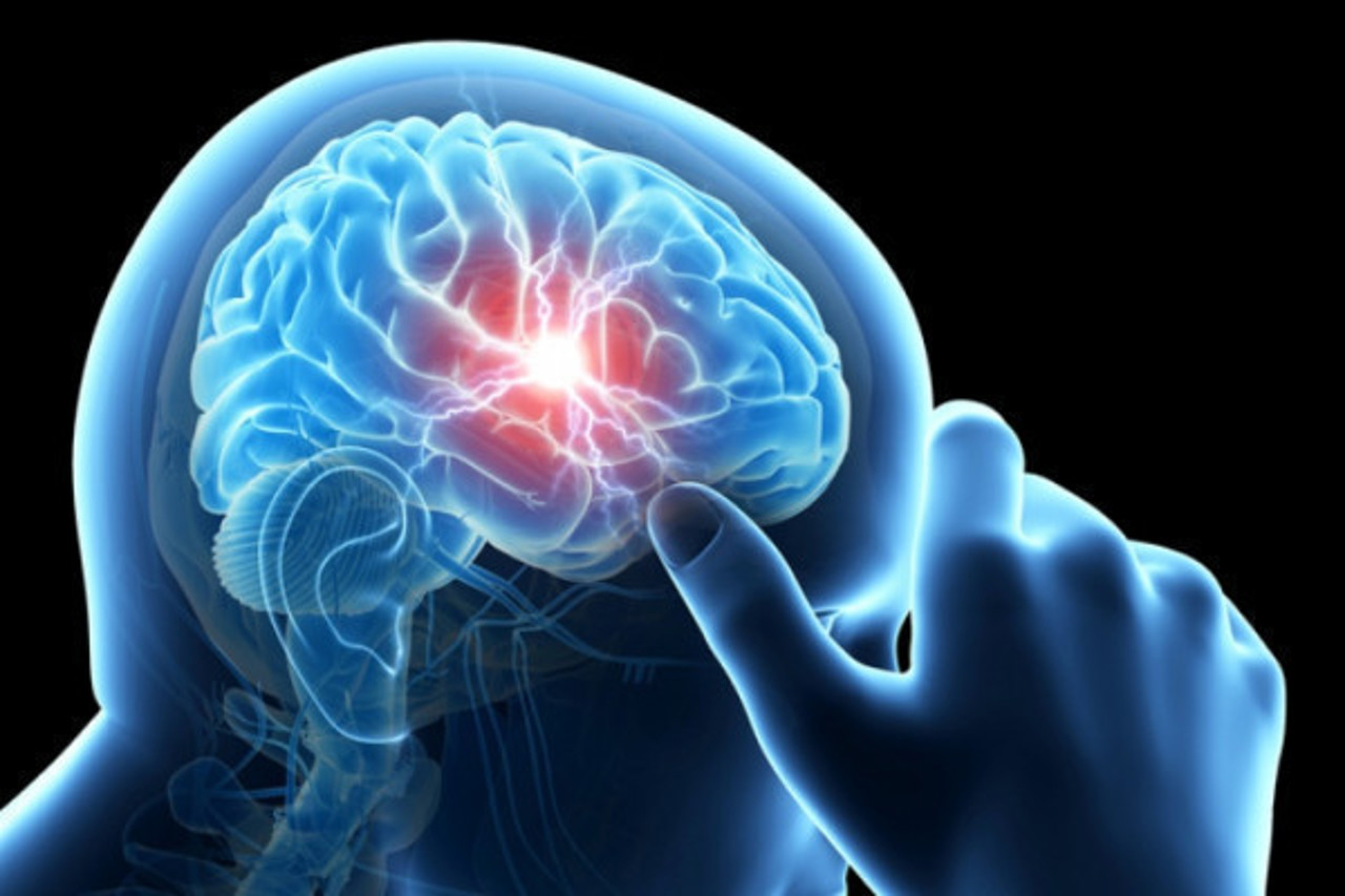 Doctors warn: up to 90% of strokes could be prevented