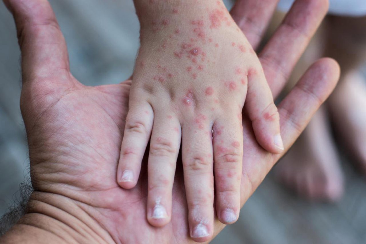 Four measles cases confirmed in Chisinau, with four more suspected