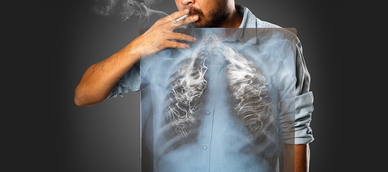 Peste 80% din decesele cauzate de cancer, asociate consumului de tutun: „Nu trebuie să așteptăm voința pentru a renunța la fumat”
