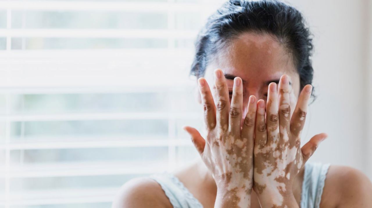 Dermatolog: Vitiligo, boala petelor albe, nu este contagios. Cauze, factori declanșatori și tratament