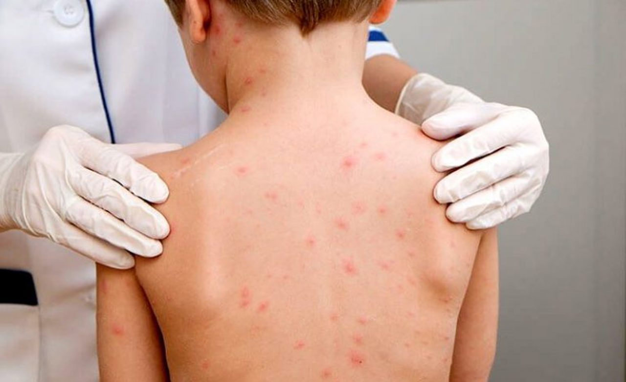 Focar de rujeolă în Bulgaria: Rata cea mai mare de infectare, la copiii sub un an