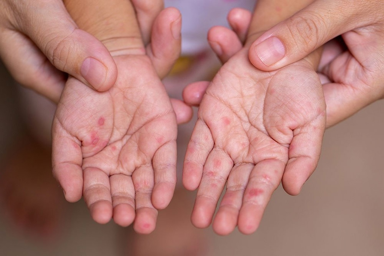 Focar de rujeolă, înregistrat într-o familie din Chișinău