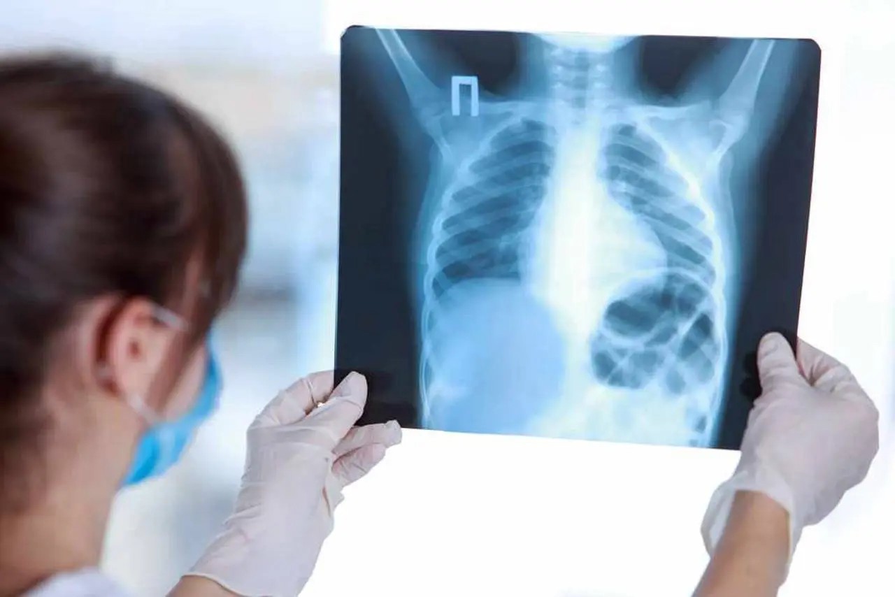 Cinci cazuri de tuberculoză, înregistrate la Chișinău
