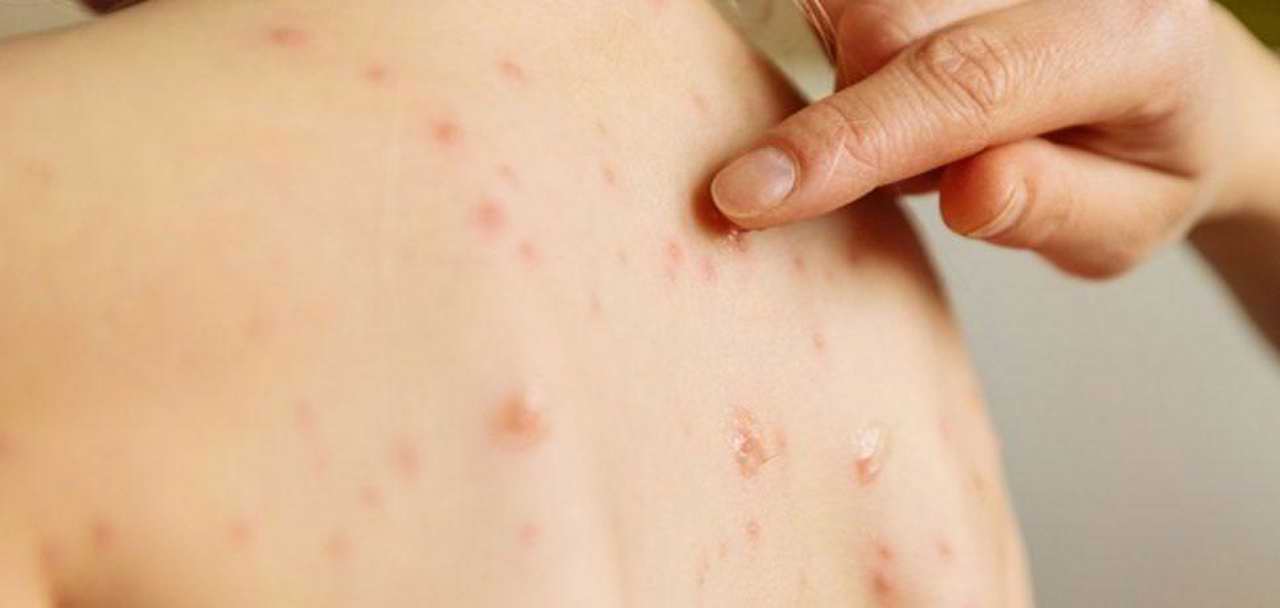 Chisinau: Measles outbreak in a family with five children