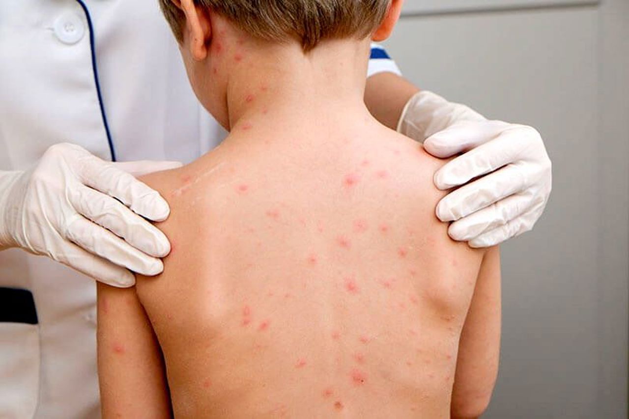 Trei cazuri noi de rujeolă la Chișinău. Medicii reiterează importanța vaccinării  