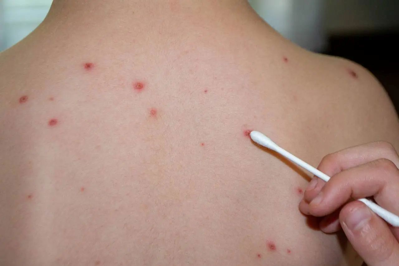 Seven cases of measles registered since the start of the year