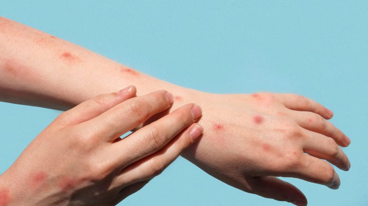 A new case of measles, confirmed in the Republic of Moldova