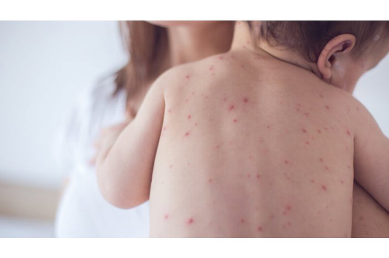 Încă două cazuri de rujeolă au fost înregistrate în Republica Moldova. Ambele în municipiul Soroca 